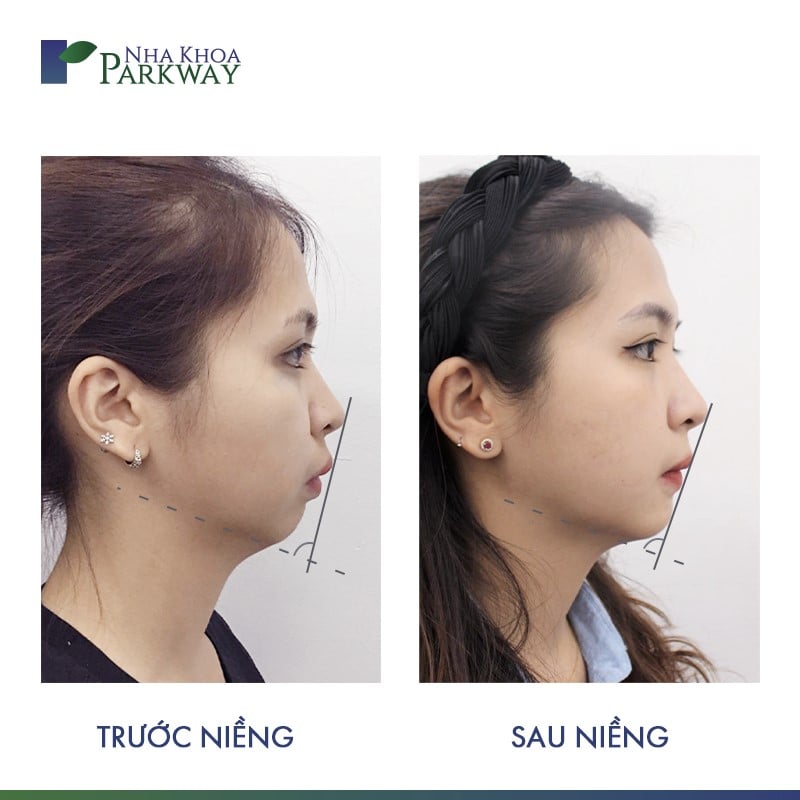 hiệu quả trước và sau niềng răng invisalign