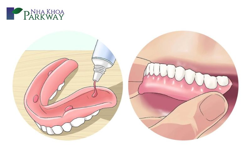 Giới thiệu về keo dán răng giả