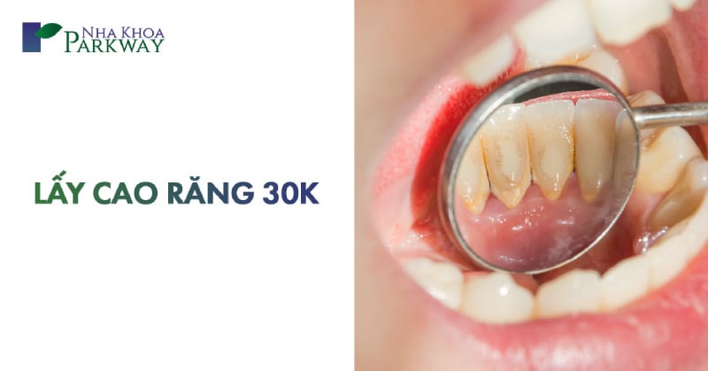 kỹ thuật lấy cao răng 30k