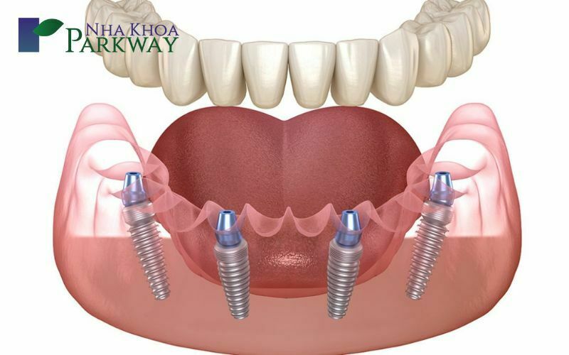 Có những phương pháp trồng răng giả nguyên hàm