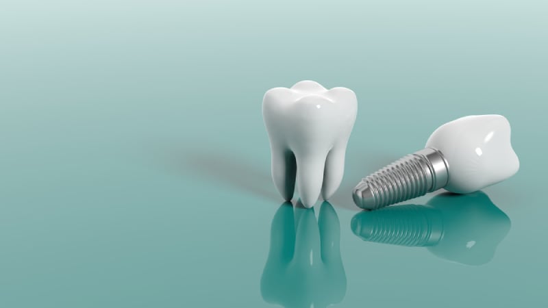 làm răng implant ở đâu tốt nhất hà nội