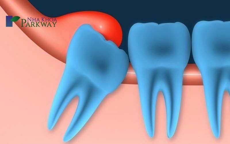 Những vị trí thường bị lợi trùm răng