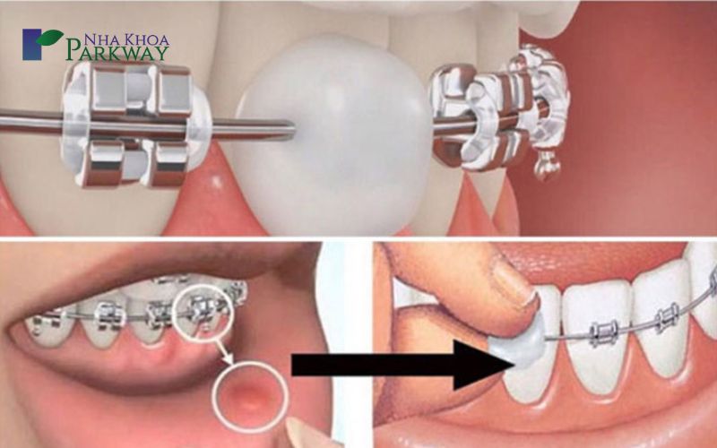 Những điều có thể gặp khi đang sử dụng Loop đóng khoảng răng cửa