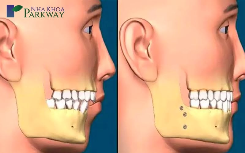 Có nên tập mewing cho răng hô khi khớp cắn phủ không ổn định?