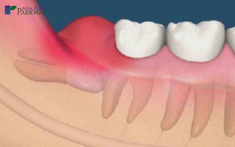 mọc răng khôn bị hành sốt mấy ngày