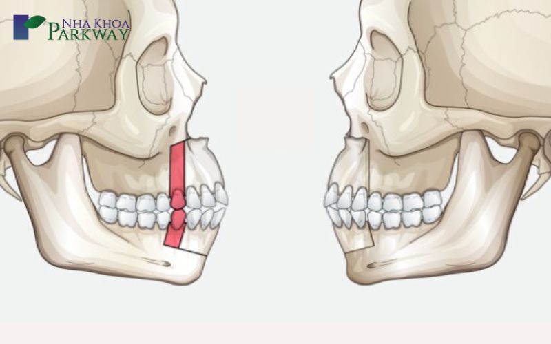 Cách khắc phục tình trạng môi dày răng hô