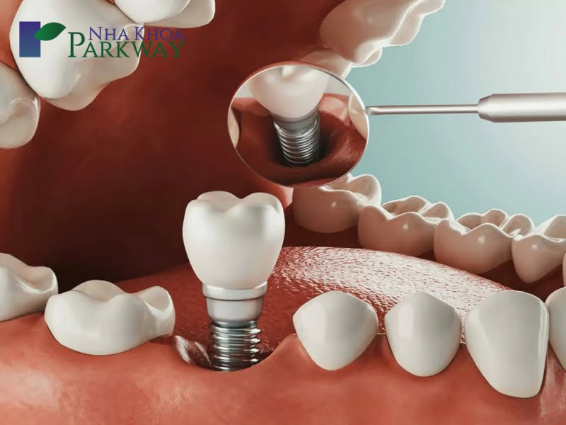 Những công nghệ làm răng giả cố định hiện nay