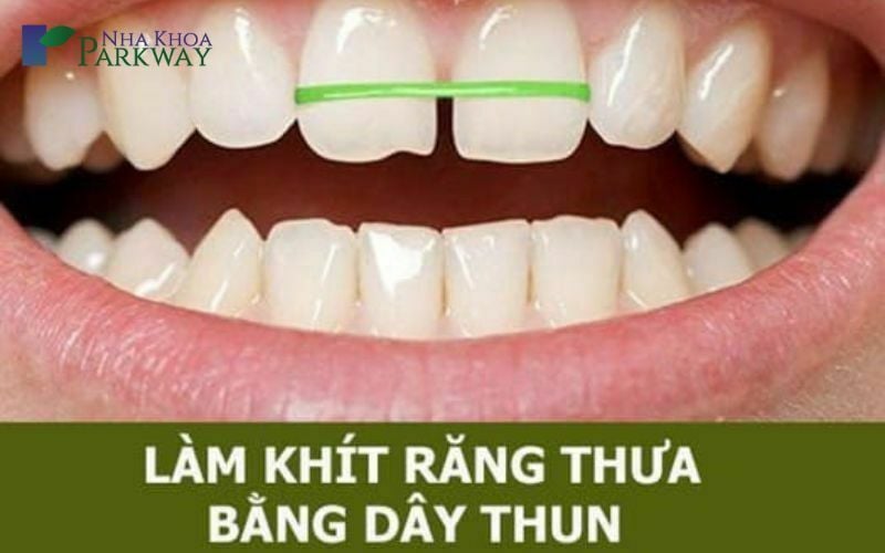 Cách chữa răng cửa thưa tại nhà