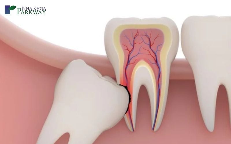 nguy hiểm khi nhổ răng khôn tới thần kinh