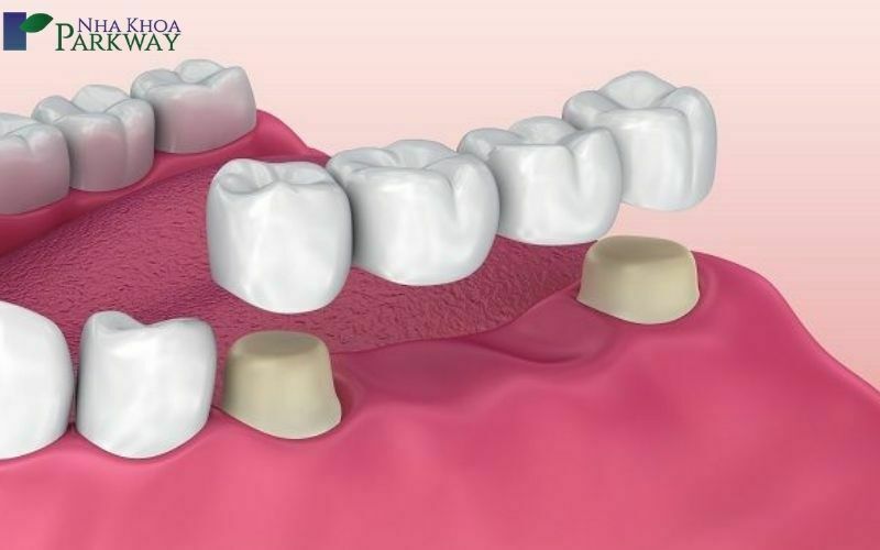 Nhiệm vụ của cầu răng sứ là để che lấp khoảng trống của răng đã mất