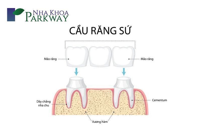 Phương pháp trồng răng sau khi nhổ răng hàm bị sâu bằng cầu răng sứ (Nguồn ảnh: Internet)