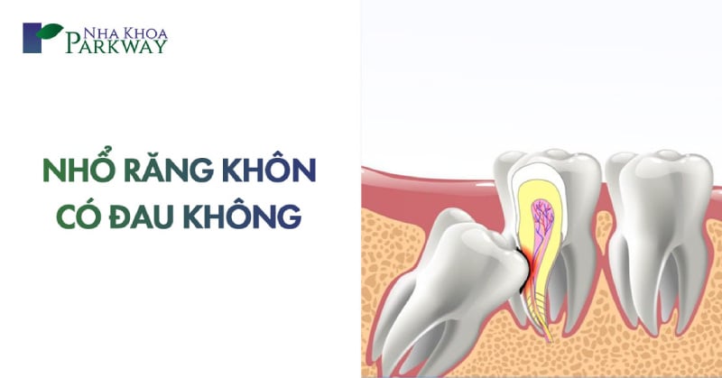 sau khi nhổ răng khôn có đau không