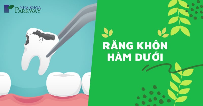 nhổ răng khôn hàm dưới bao nhiêu tiền