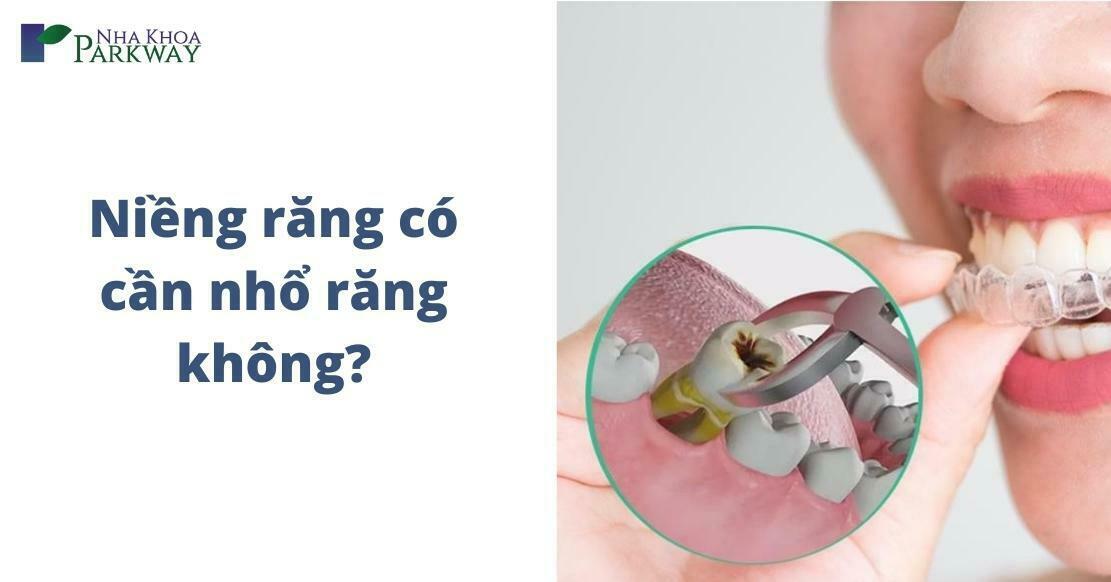 niềng răng có cần nhổ răng không