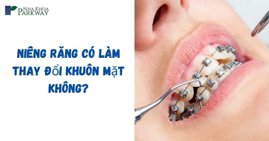 niềng răng có làm thay đổi khuôn mặt không