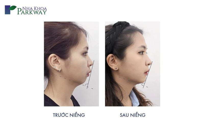 Hình ảnh trước và sau khi niềng răng hô hàm trên