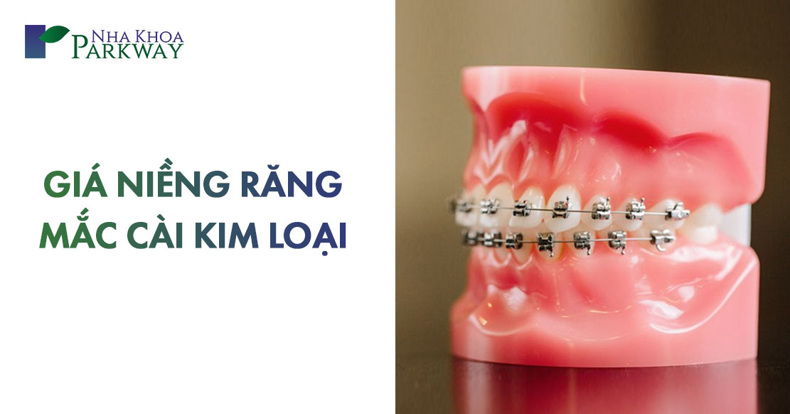 niềng răng mắc cài kim loại