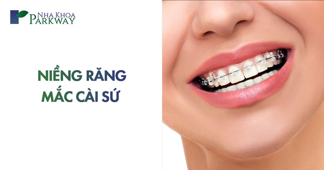 Niềng răng mắc cài sứ