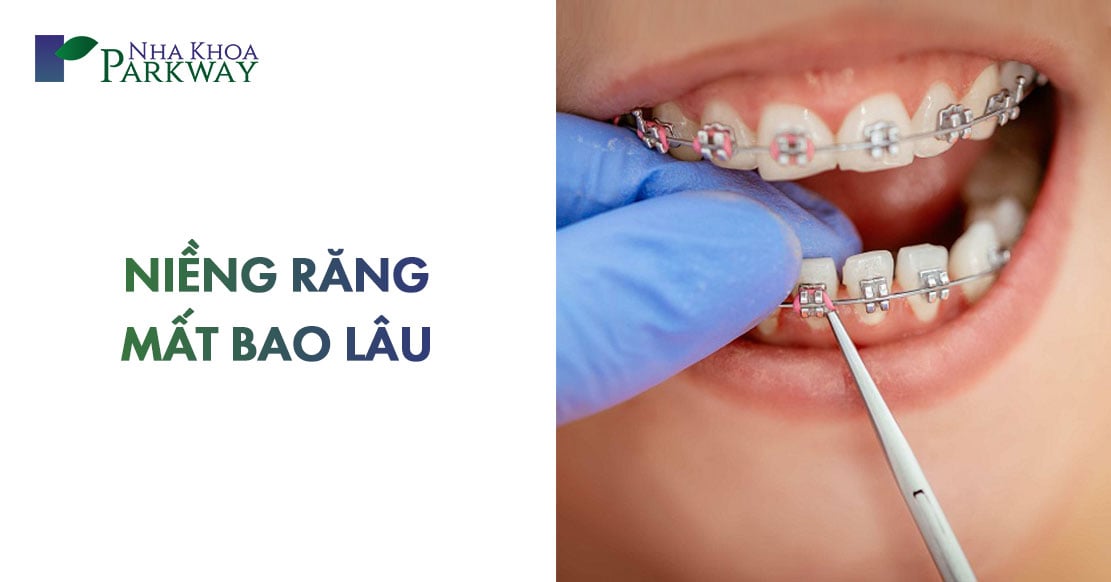 niềng răng mất bao lâu