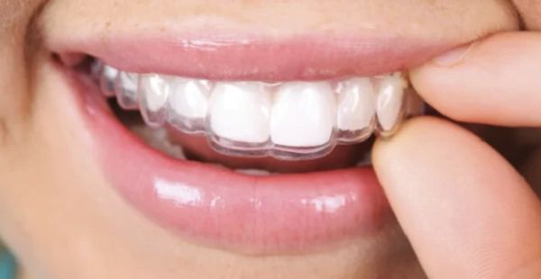 Niềng răng không mắc cài Invisalign