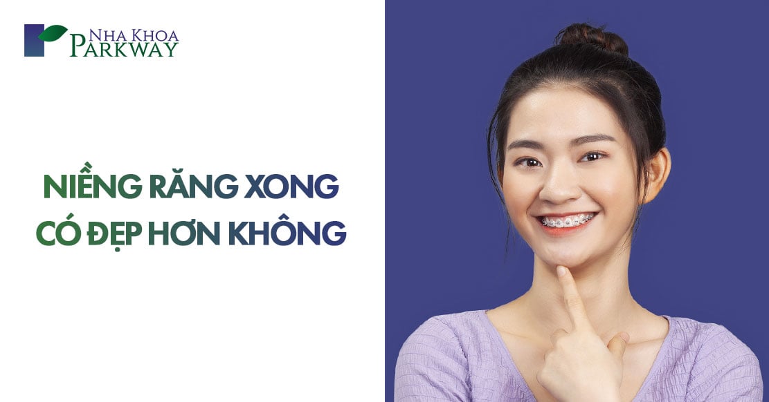 niềng răng xong có đẹp hơn không