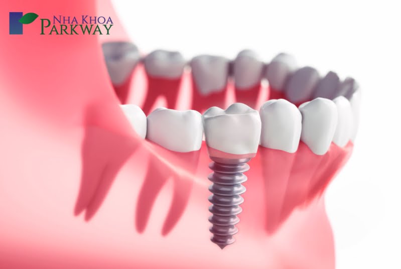 Trồng răng Implant để không bị nuốt răng giả vào bụng