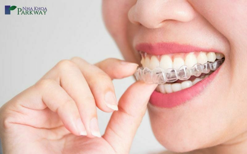 Phương pháp Invisalign