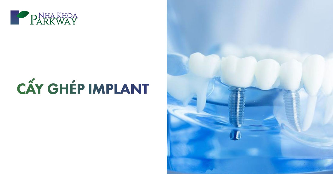 quy trình cấy ghép implant là gì