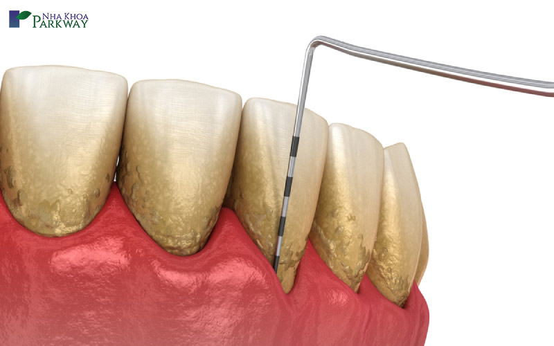 quy trình lấy cao răng như thế nào là tốt