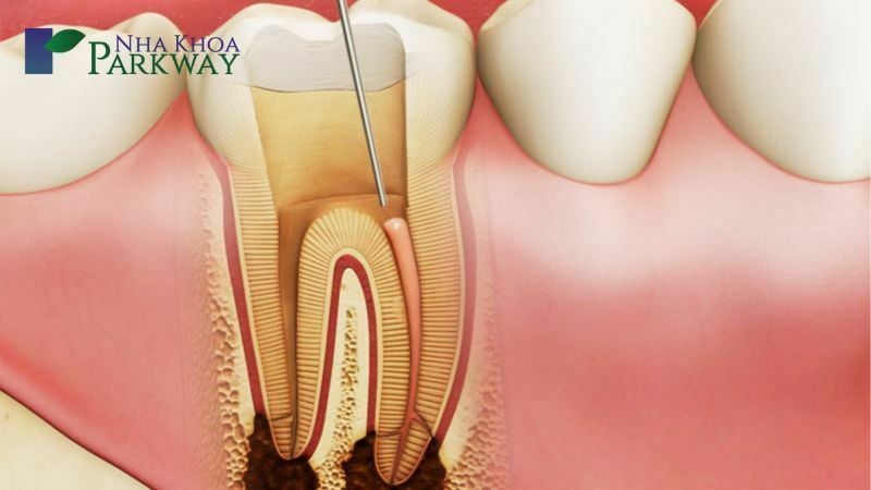 Các bước trong quy trình lấy tủy răng