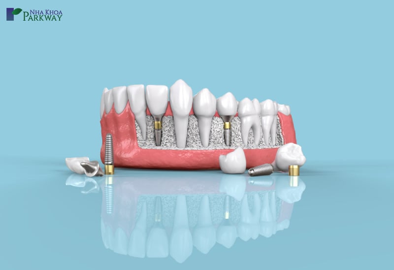 quy trình trồng răng implant là như thế nào