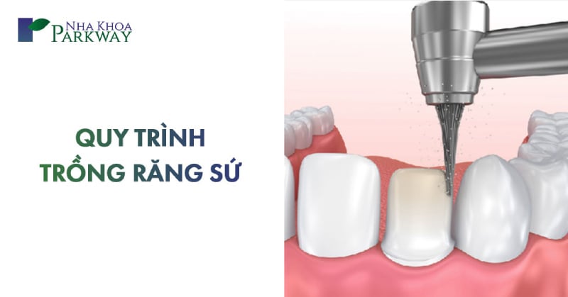 quy trình trồng răng sứ mất bao lâu xong