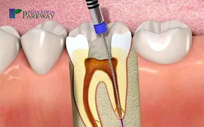 Cần vệ sinh răng miệng đúng cách để bảo vệ tủy răng 