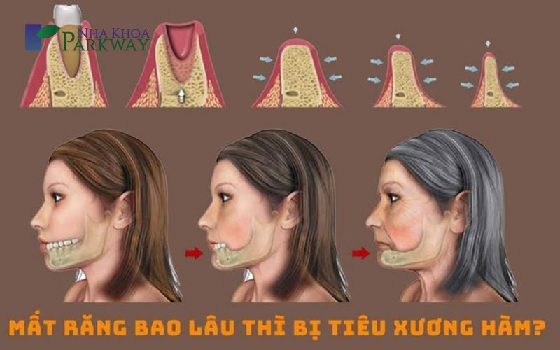 Mất răng cửa đem lại hậu quả như thế nào?