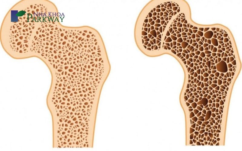 Nguyên nhân răng cửa lung lay