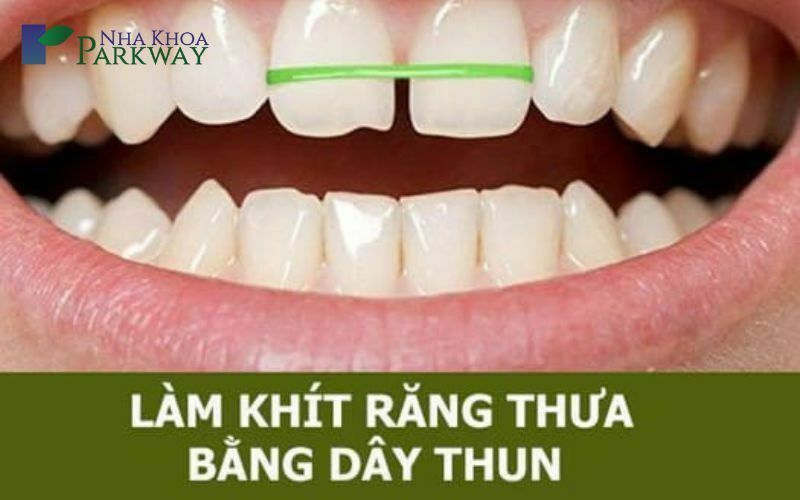 Cách khắc phục răng cửa thưa tại nhà