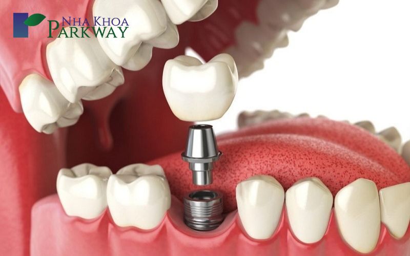 Làm răng nhân tạo bằng phương pháp cấy ghép implant