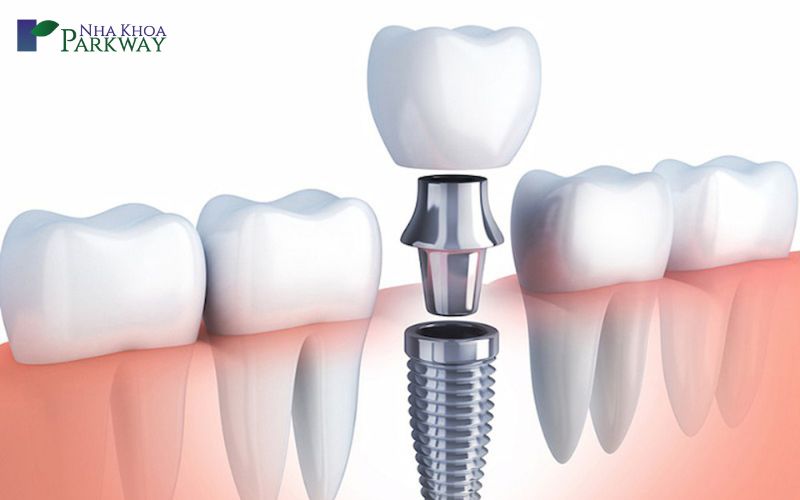 Trồng răng giả có thể thi quân đội hay không?