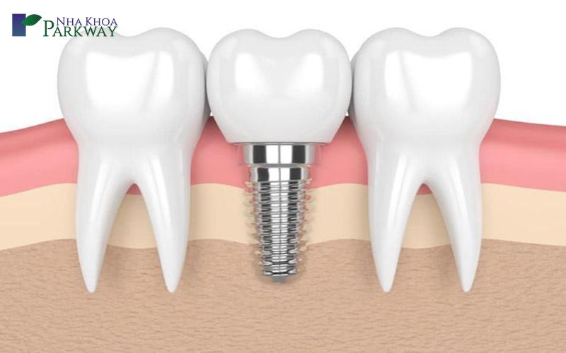 Trồng răng giả có được thi công an hay không?