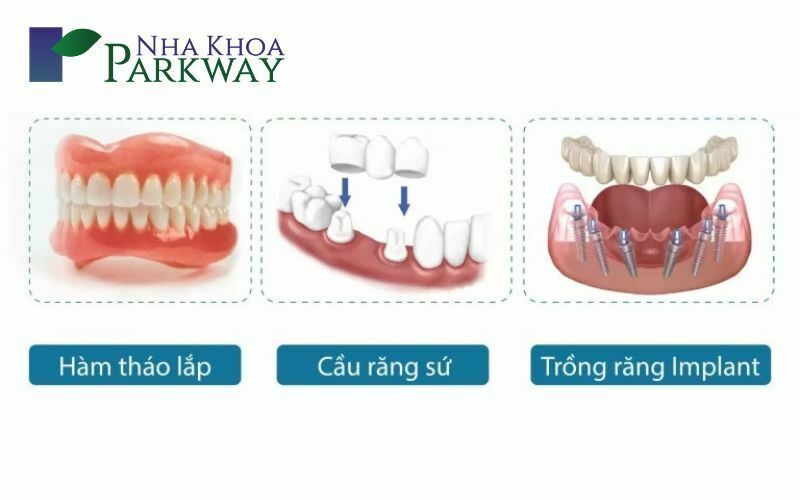 Phương pháp trồng răng giả là gì?