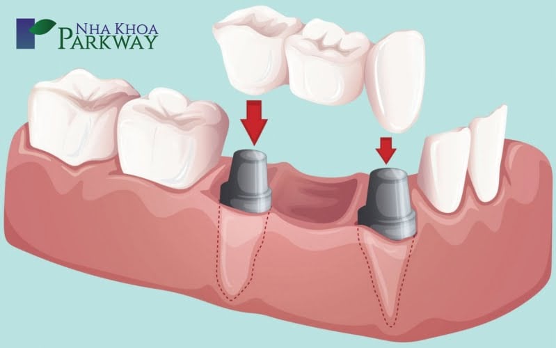 Những phương pháp phục hình tốt nhất thay thế việc làm răng giả tháo lắp 1 chiếc