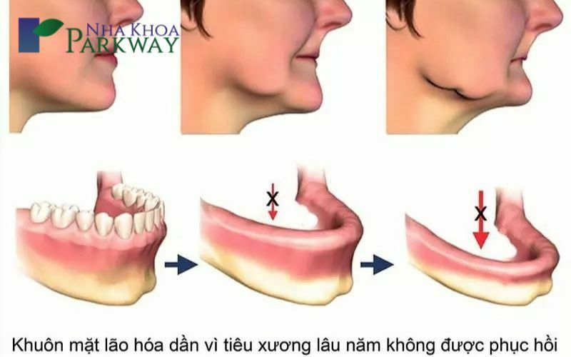 Ưu nhược điểm của trồng răng giả tháo lắp