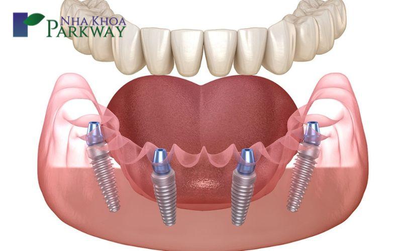 Có mấy loại răng giả tháo lắp hiện nay?