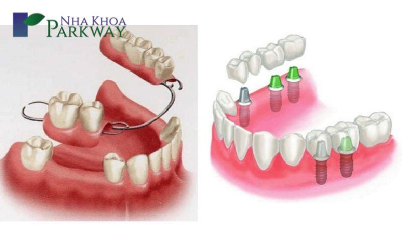 Giới thiệu sơ qua về răng giả tháo lắp