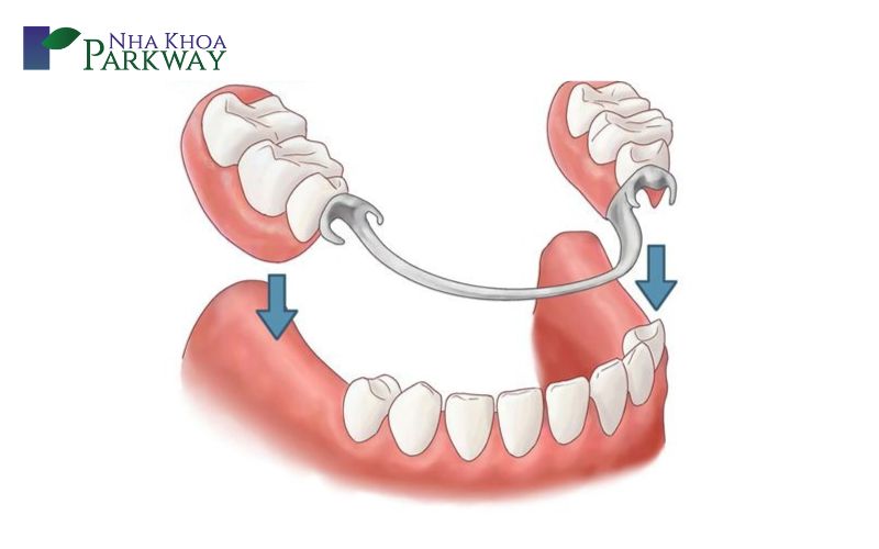 Các loại răng giả tháo lắp nhựa dẻo hiện nay