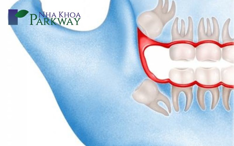 Vài trường hợp răng khôn mọc lệch thường thấy