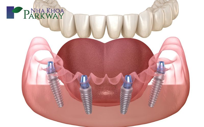 Cách làm răng khểnh giả tại nha khoa bằng phương pháp Implant