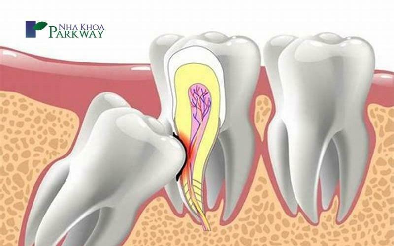 Nguyên nhân dẫn đến sâu răng khôn.