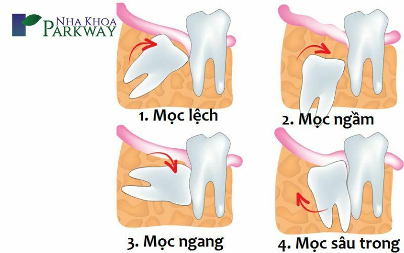 Răng khôn hiếm khi mọc thẳng: