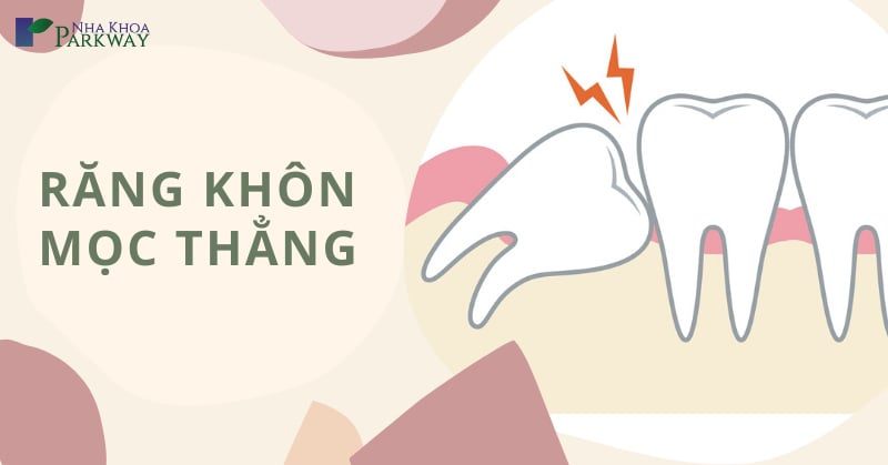 răng khôn mọc thẳng có nên nhổ không